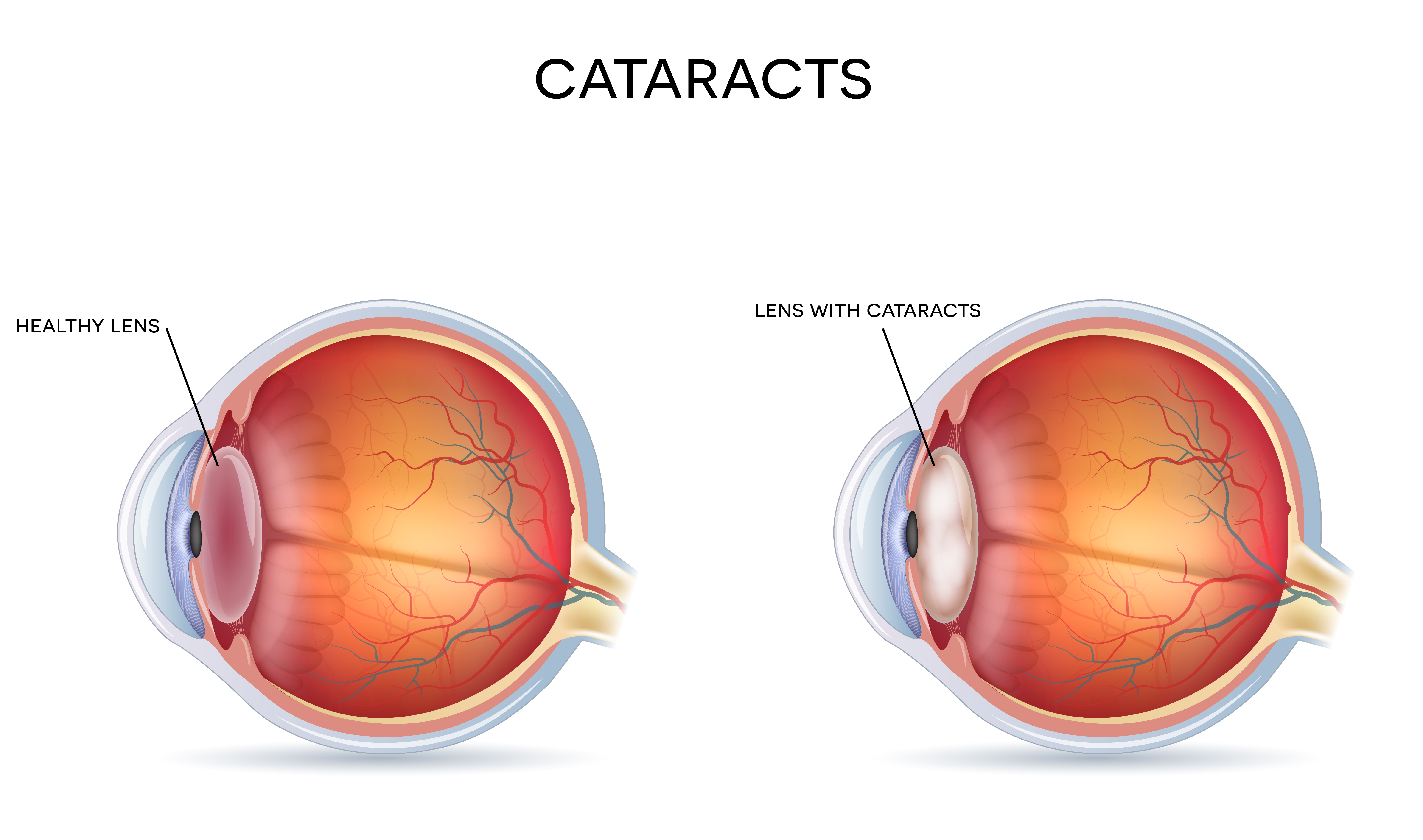 Cataract Image